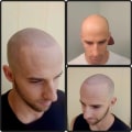 Understanding Scalp Micropigmentation for Aesthetic Enhancements