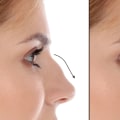 Understanding Open Rhinoplasty for Facial Enhancement