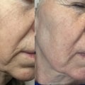 Understanding Fractional Laser Resurfacing for Skin Rejuvenation