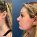 A Comprehensive Look at Rhinoplasty Reviews