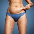 Understanding Liposuction: A Comprehensive Guide to Body Contouring