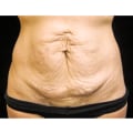 Traditional Tummy Tuck: Achieving Your Dream Body