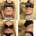 Tummy Tuck Reviews: Real People Share Their Experiences