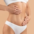 Understanding Tummy Tucks: Enhancing Your Appearance and Addressing Body Concerns