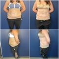 Understanding the Extended Tummy Tuck Procedure