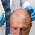 The Many Benefits of Hair Transplant Procedures