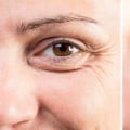 All You Need to Know About Eyelid Surgery: Enhancing Your Appearance and Addressing Skin Concerns