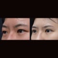 How Asian Eyelid Surgery Can Enhance Your Appearance