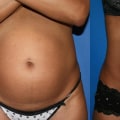 Understanding Laser Liposuction