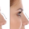 Rhinoplasty: Enhance Your Appearance with Cosmetic Surgery