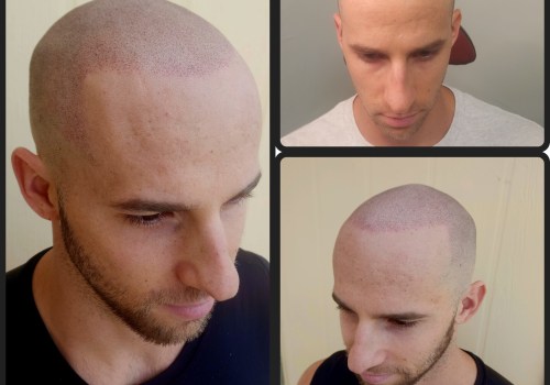 Understanding Scalp Micropigmentation for Aesthetic Enhancements