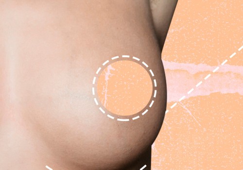 Understanding Breast Augmentation: Everything You Need to Know