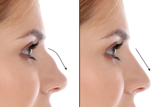 Understanding Open Rhinoplasty for Facial Enhancement