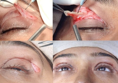 All You Need to Know About Upper Blepharoplasty