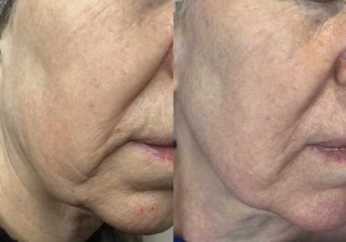 Understanding Fractional Laser Resurfacing for Skin Rejuvenation