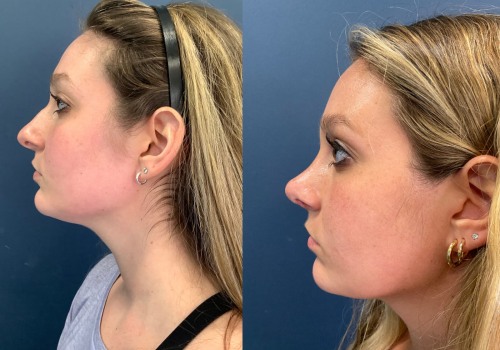 A Comprehensive Look at Rhinoplasty Reviews