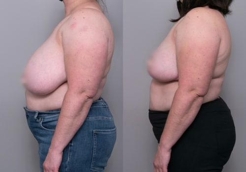 A Comprehensive Look at Breast Reduction Procedures