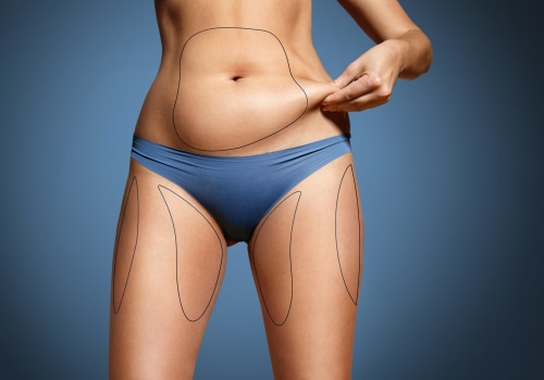 Understanding Liposuction: A Comprehensive Guide to Body Contouring