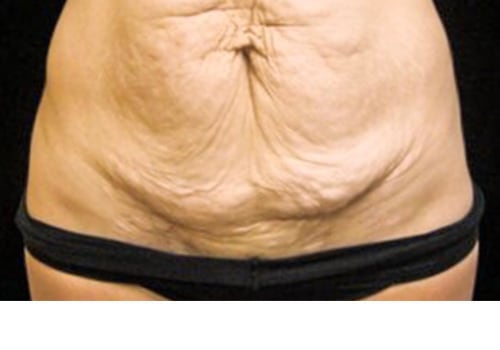 Traditional Tummy Tuck: Achieving Your Dream Body