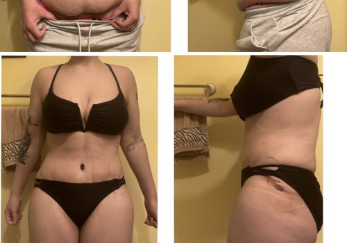 Tummy Tuck Reviews: Real People Share Their Experiences