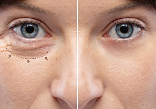 Lower Blepharoplasty: Enhancing Your Appearance with Eyelid Surgery