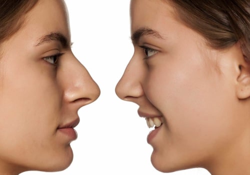 Closed Rhinoplasty: Enhancing Your Appearance Through a Safe and Effective Procedure