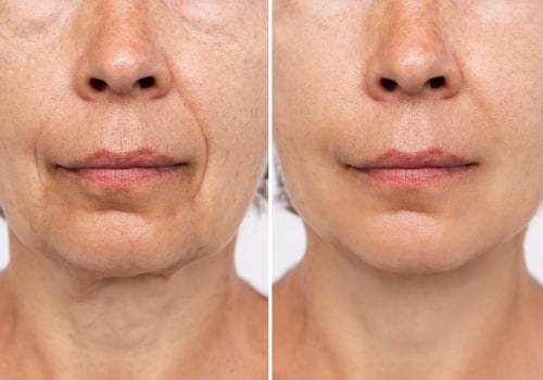 Reduced signs of aging: Enhancing Your Appearance with Cosmetic Procedures