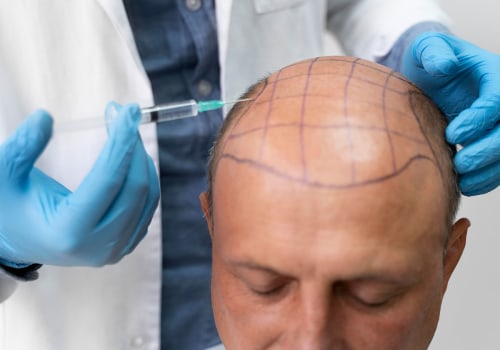 The Many Benefits of Hair Transplant Procedures