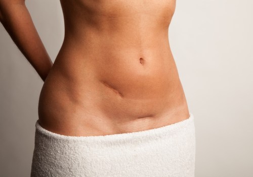 Understanding Mini Tummy Tucks: A Comprehensive Guide to Body Contouring