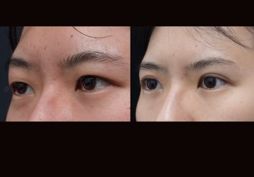 How Asian Eyelid Surgery Can Enhance Your Appearance