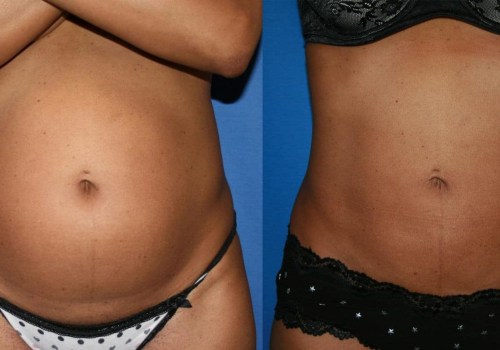 Understanding Laser Liposuction