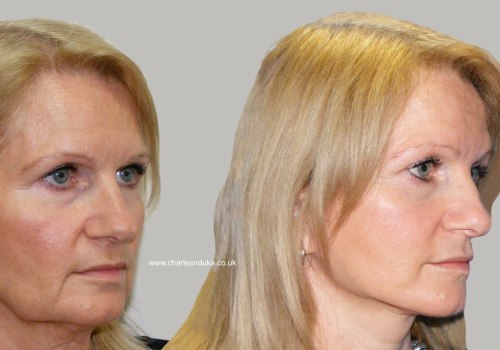 All You Need to Know About Traditional Facelift