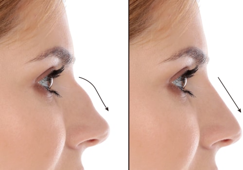 Rhinoplasty: Enhance Your Appearance with Cosmetic Surgery